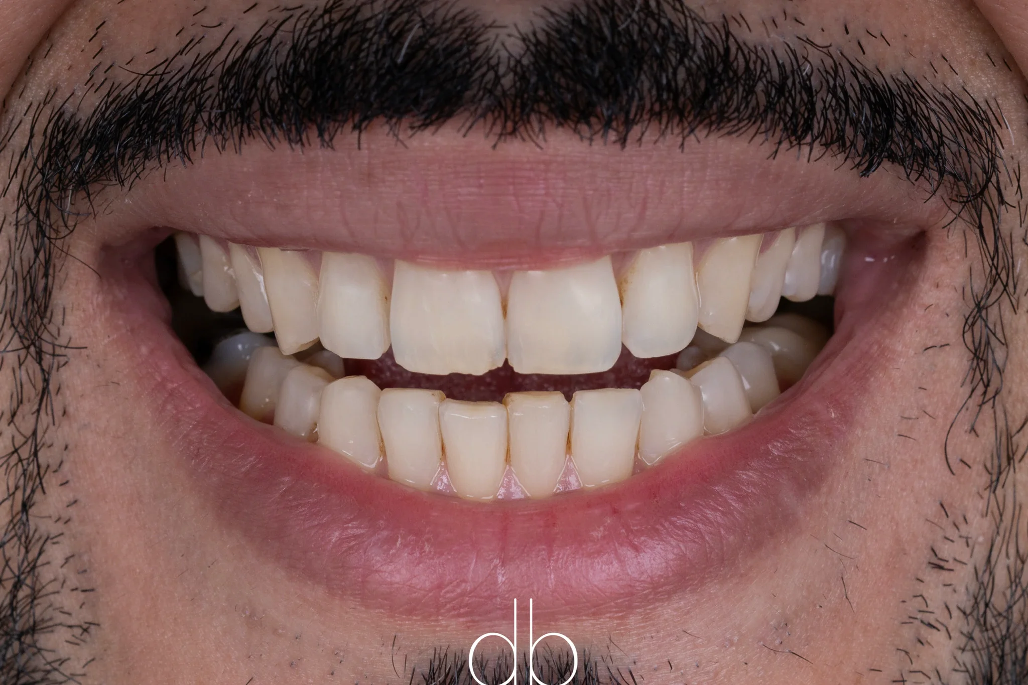 Before