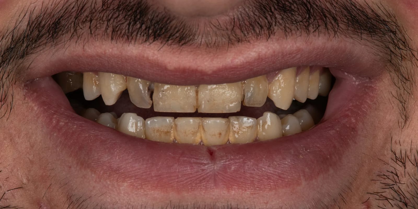 Smile 02: Before