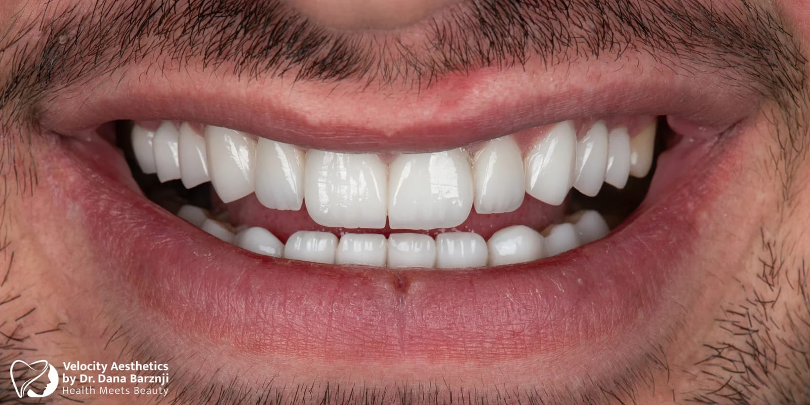 Smile 02: After