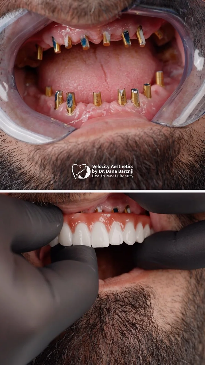 Dental Implants